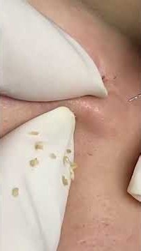 Relax and watch this satisfying acne and blackhead extraction video. #0010 #Pimple #acne #blackheads