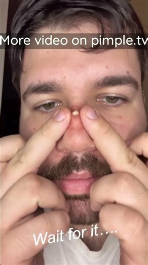 Blackheads Removal | Acne Treatment and Very Satisfying Satisfying Pimple pop #blackheads