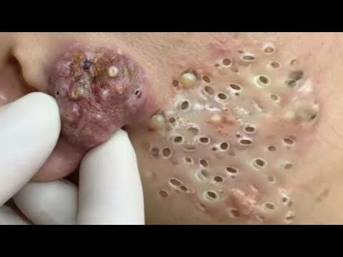 Deep blackhead Removal 2026, acne removal spa, big pimple 2026, #acne #pimple #cyst