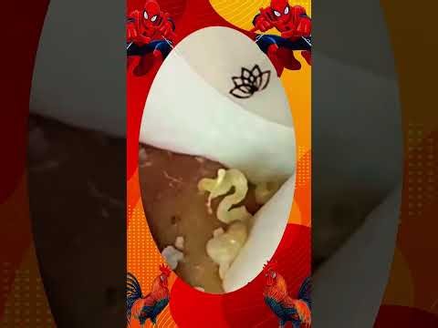 Blackheads Removal #508 | Acne Treatment and Very Satisfying Satisfying Pimple pop #blackheads