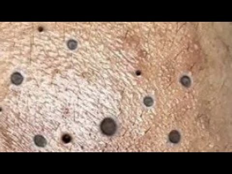 Best Satisfying Pimples Popping Cyst Removal Acne Blackheads Explosive Compilation Videos #307
