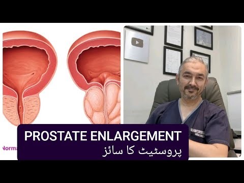 PROSTATE ENLARGEMENT|پروسٹیٹ کا سائز | when to treat? | By Dr. Fartash Sarwar | Urdu/Hindi