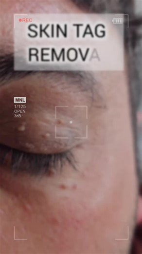 Skin tag removal laser saif medical center Sakhakot Bazar near Allied bank #fibroblast #exosomes #Pigmentation #whiteninginjection #LaserHairRemoval