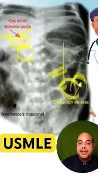 Necrotizing enterocolitis #usmle #medicine #usmlelatino #doctor