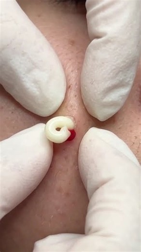 Popping Satisfying Pimple🌋😲