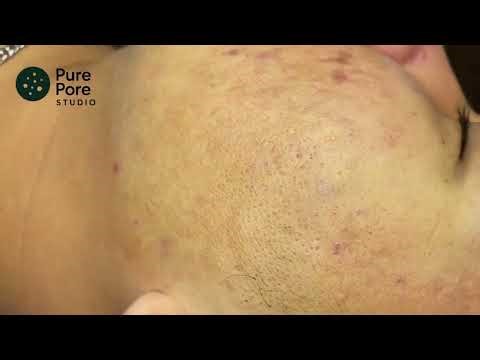 Extreme Acne & Blackhead Removal | Deep Pimple Popping That Will Shock You! ✅#acneremoval