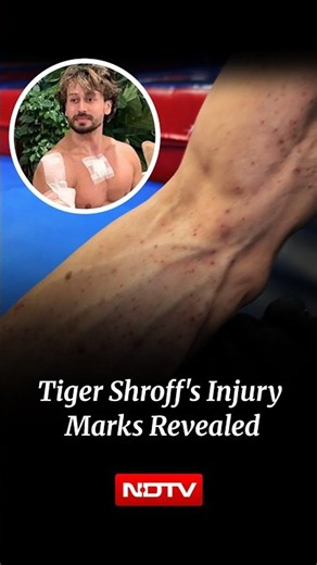 Tiger Shroff | Tiger Shroff's Team Shares Video Showing Bruises, Pellet Marks After Firing