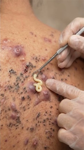 Advanced Skin Extraction Treatment for Multiple Blemishes