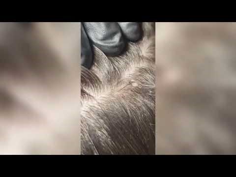 Pimple Popping - Ultimate Pimple Popping Compilation#109