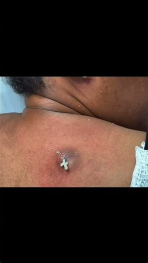 cyst extraction 🫣 #oddlysatisfying #pimplepopping
