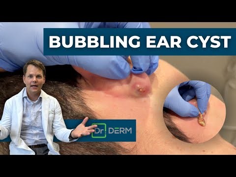 Draining A Bubbling Ear Cyst! | Dr. Derm