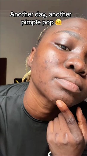 Satisfying Hard Pimple Pop for Acne Prone Skin | Timmy Ally