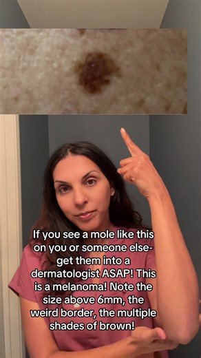 Recognizing Classic Melanoma Symptoms Early