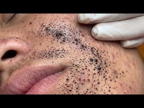 Big Cystic Blackhcads Extraction Blackheads & Milia, Whitchcads Removal #2060
