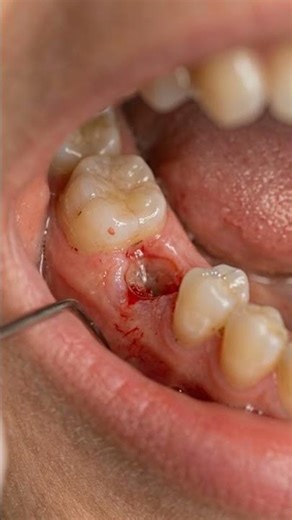 Missing tooth transformation 🦷 #shorts