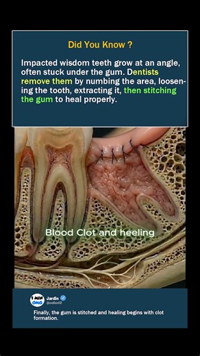 How Wisdom Teeth Are Removed (Step by Step)