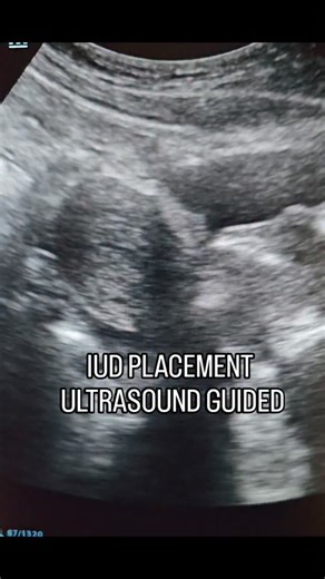 Iikia Poitier-Outing on Instagram: "Can you see the IUD placement? #ultrasound #iud #contraceptive #birthcontrol #fyp"