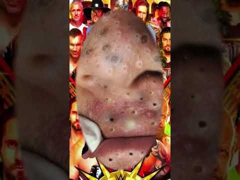 Blackheads Removal #623 | Acne Treatment and Very Satisfying Satisfying Pimple pop #blackheads