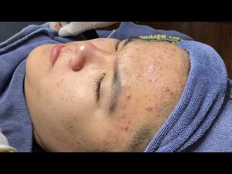 Acne Treatment for High School Students | Loan Nguyen Acne Treatment Official