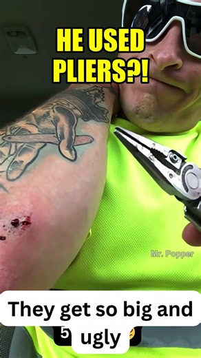 He used pliers on his own arm