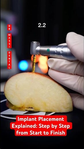 Implant Placement Explained: 🔩 Step by Step from Start to Finish