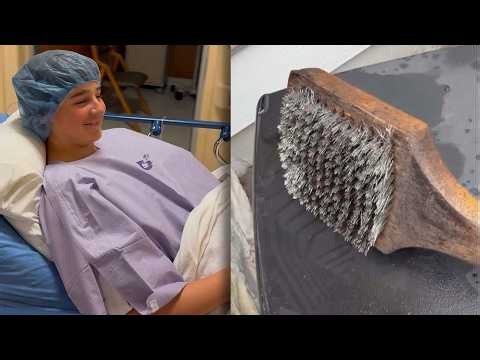 Minnesota Teen Has Emergency Surgery After Swallowing Bristle Brush Needle