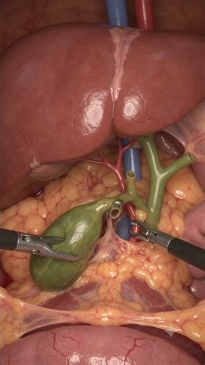 How Is Gallbladder Surgery Performed? | Laparoscopic Cholecystectomy #shorts