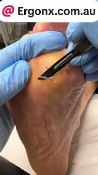 Diabetic Foot Care: Treating Corns & Calluses with Ulceration | #PodiatryTips #FootHealth