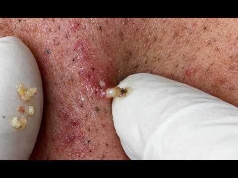 NEW 2026 – Huge Pimple Removal & Deep Skin Cleansing#10372