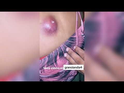 Popping huge blackheads and Pimple Popping - Best Pimple Popping Videos 295