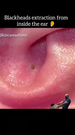 Blackhead Extraction from Inside the Ear: Safe Steps & What to Expect