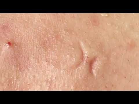 Deep Pore Cleansing & Blackhead Removal 🧖‍♀️✨ | Sac Dep Spa Care