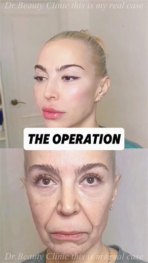 Small-cut lift that tightens your face naturally with quick recovery. #MiniLift #FaceTight