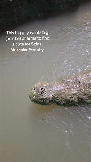 Spinal Muscular Atrophy (SMA) is a human genetic condition that causes progressive muscle weakness and wasting (atrophy) by affecting the nerve cells (motor neurons) in the spinal cord that control voluntary muscles, impacting abilities like walking, breathing, and swallowing. #spinalmuscularatrophy #curesma #neurology #pediatricneurology #motorneuronedisease