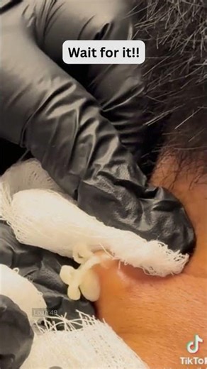 Deep Blackheads, Milia & Whitehead Removal pimple popping New| Big Cystic Acne Extraction #1233 2026