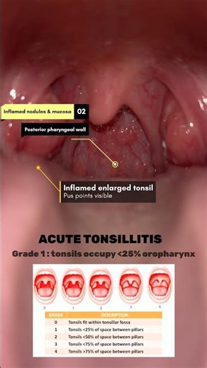 ACUTE TONSILLITIS || sore throat with inflamed tonsils and painful swallowing.