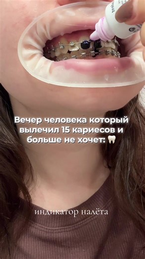 #брекеты #зубы #стоматология #кариес #уход | tooth cleaning