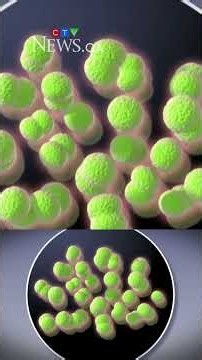 Sask. IMD outbreak raises concerns, prompts prevention reminders