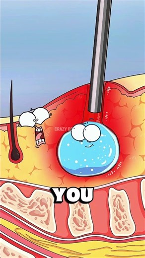 Inside Skin Cyst Removal!