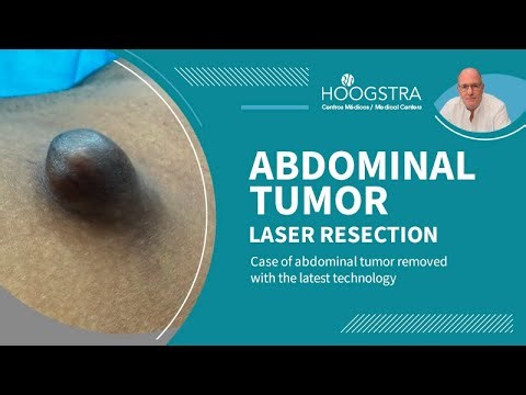 Laser resection of abdominal tumor - 25208