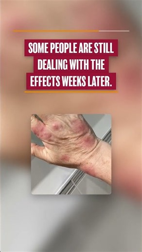 Bed Bugs in Your Hotel? Here’s What to Do