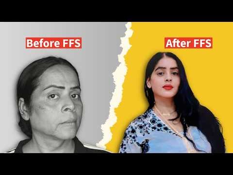 She looks younger now! | Facial Feminization Surgery Real Results Before & After | Dr Vaibhav Shah