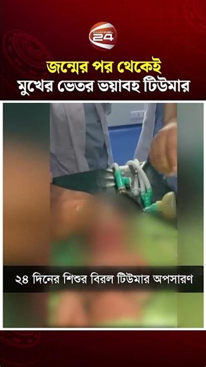 জীবন ফিরে পেল ২৪ দিনের শিশু: দুই ঘণ্টার জটিল অস্ত্রোপচারে বিরল টিউমার সফল অপসারণ