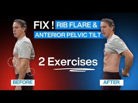 Fix Anterior Pelvic Tilt & Rib Flare PERMANENTLY - 2 Exercises That Actually Work!