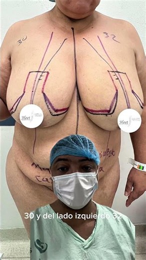 Reducción mamaria: funcionalidad, proporción y bienestar.