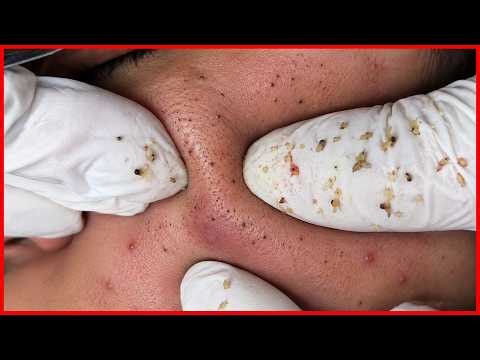 🔴 LIVE 3.6.9 Blackheads Removal | How to get Rid of Blackheads on the fac | ACNE Treatment