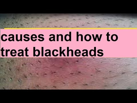 causes and how to remove blackheads