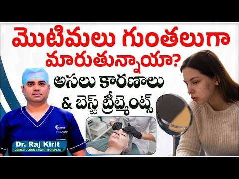 How to Get Rid of Pimples, Marks & Pits | Causes, Types, Diet & Treatments | CelesteeSkin&HairClinic