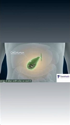 Gallbladder Surgery Explained | 3D Medical Animation|TrucoHealth