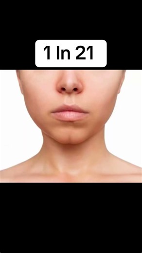 Rarest Human Genetics In The World 😳 #viral #fyp #viralvideo #viralshorts